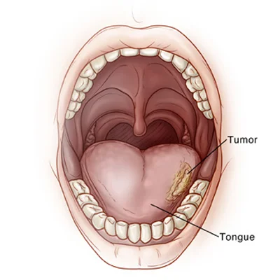 tonguecancer