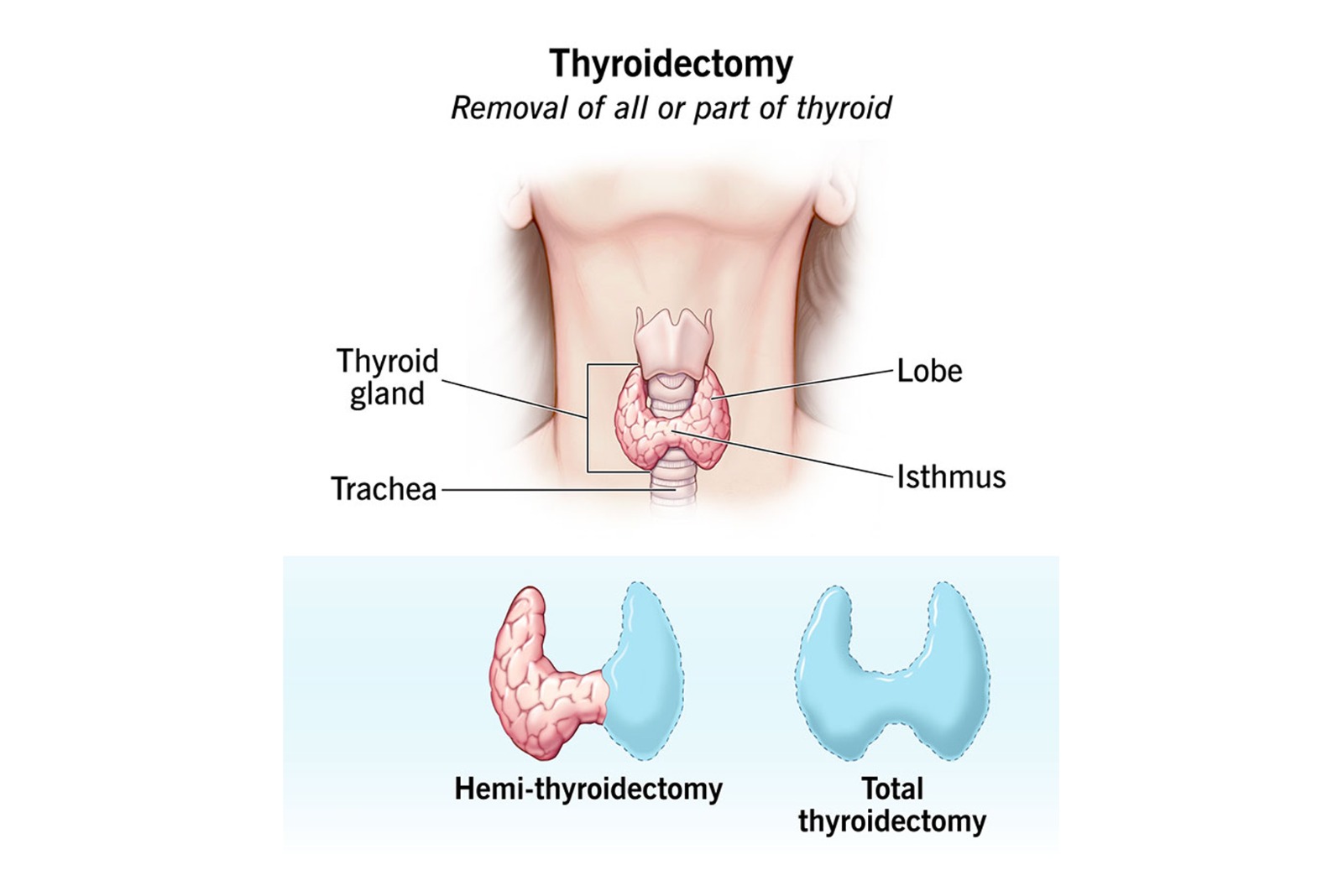 septoplasty