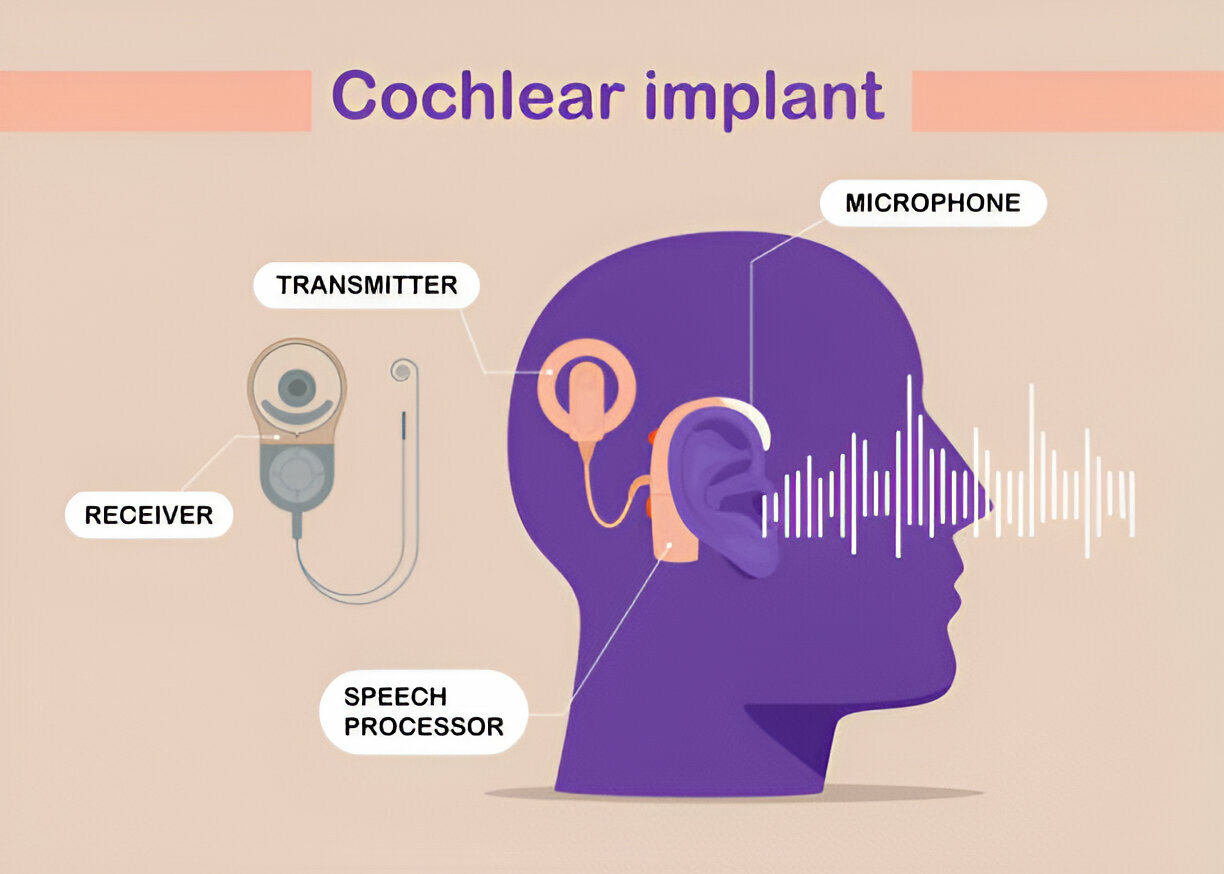 Cochlear Implant Surgery