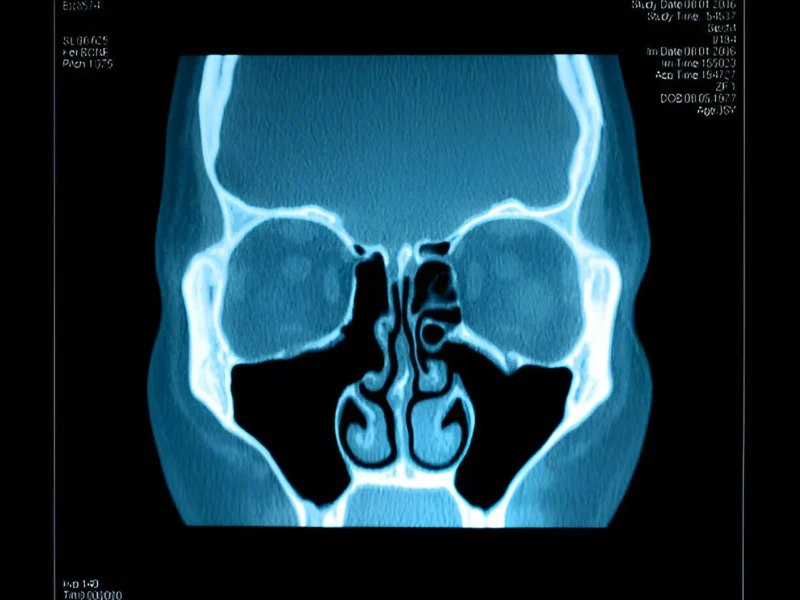 Sinus Infection – Types, Symptoms, Treatment