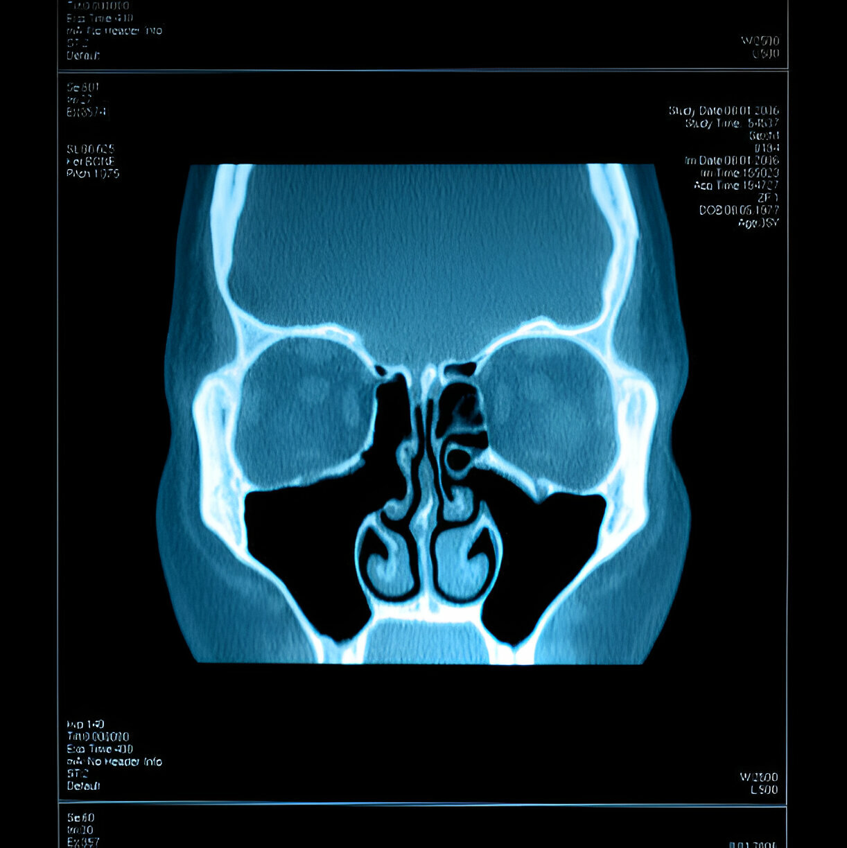 Sinus Infection - Types, Symptoms, Treatment